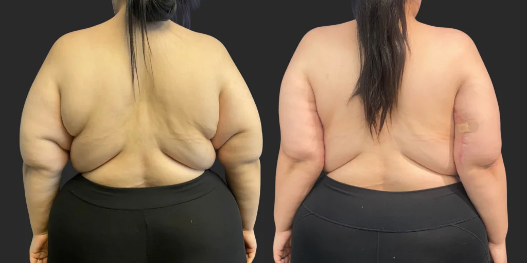 Arm Lift (Brachioplasty) #005, before and after photo, view 3