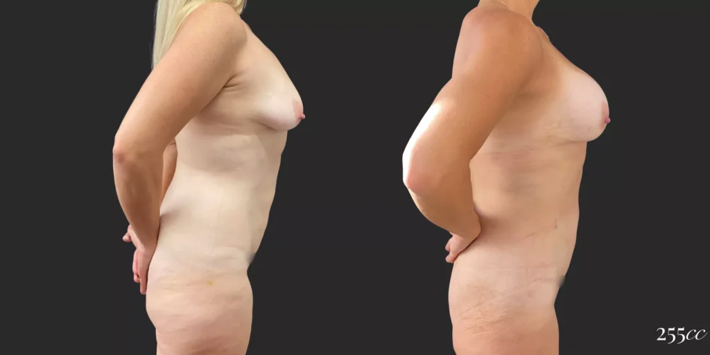 Breast Augmentation and Lipo of Hips/Waist #93, before and after photo, view 3