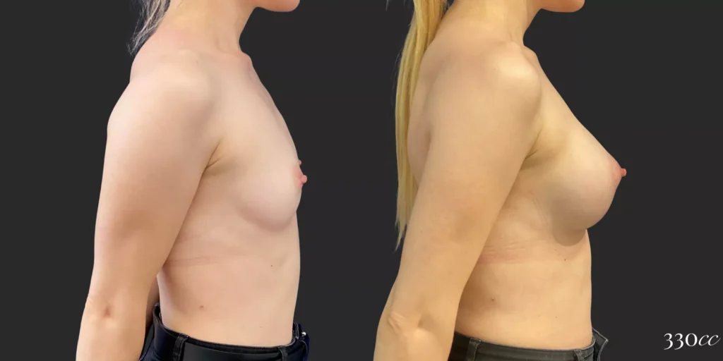 Breast Augmentation #95, before and after photo, view 3