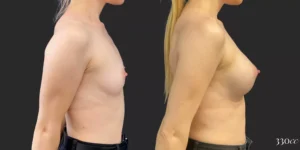Breast Augmentation #95, before and after photo, view 3