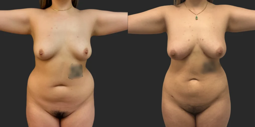 360 LBA #007, before and after photo