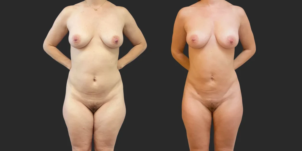 360 Lipo + Inner/Outer Thighs & Knees with Fat Transfer to Breasts #020, before and after photo