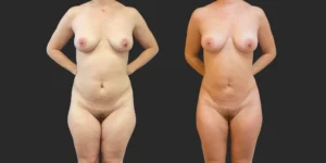 360 Lipo + Inner/Outer Thighs & Knees with Fat Transfer to Breasts #020, before and after photo