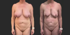 360 Lipo + Lipo of Bilateral Breasts #011, before and after photo
