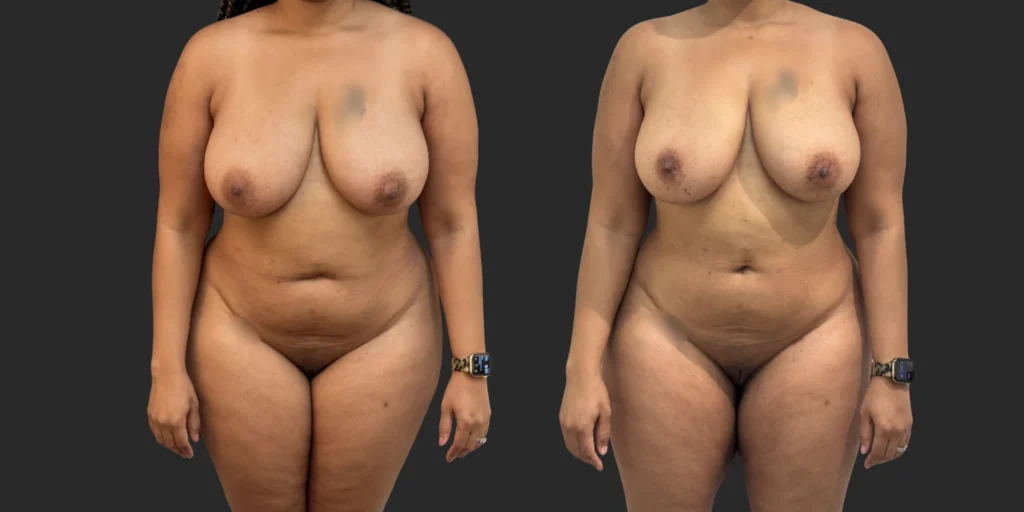 360 Lipo + Outer Thighs #012, before and after photo