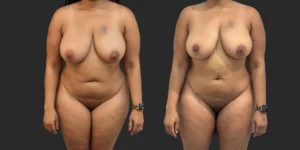 360 Lipo + Outer Thighs #012, before and after photo