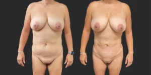360 Lipo with Fat Transfer to Buttocks #028, before and after photo