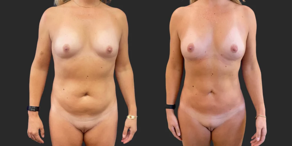 360 Lipo with Fat Transfer to Breasts #027, before and after photo
