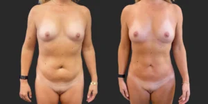 360 Lipo with Fat Transfer to Breasts #027, before and after photo