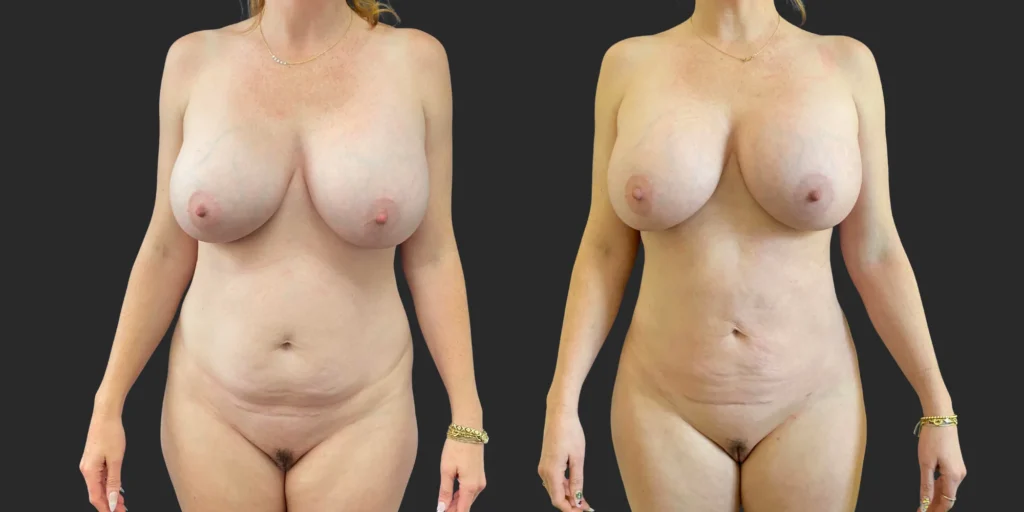 360 Lipo + Outer Thighs #022, before and after photo
