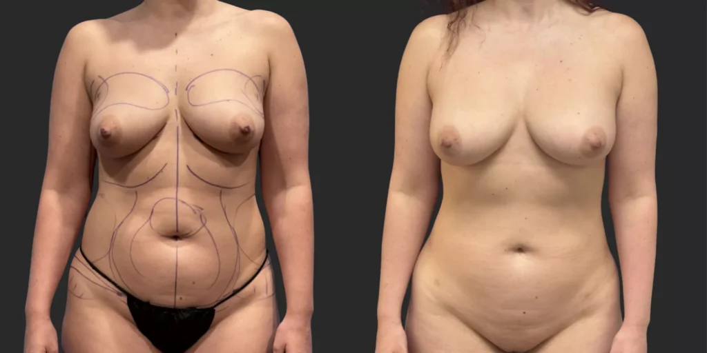 360 LBA plus Liposuction of Arms #008, before and after photo