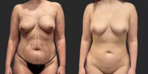 360 LBA plus Liposuction of Arms #008, before and after photo