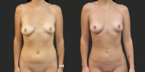 360 Lipo #009, before and after photo