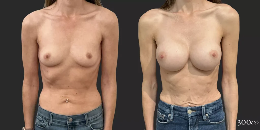 Breast Augmentation #90, before and after photo