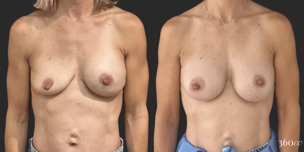 On Top® Pocket Change #7, before and after photo
