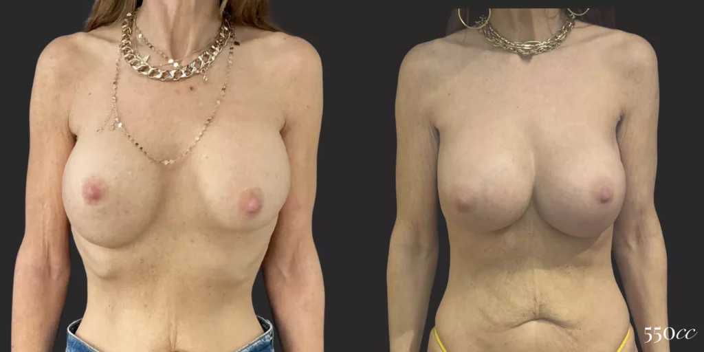 On Top® Pocket Change #9, before and after photo