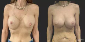 On Top® Pocket Change #9, before and after photo