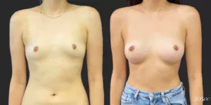 Breast Augmentation #98, before and after photo