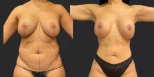 360 Lipo #018, before and after photo