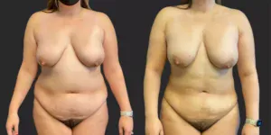 360 Lipo #019, before and after photo