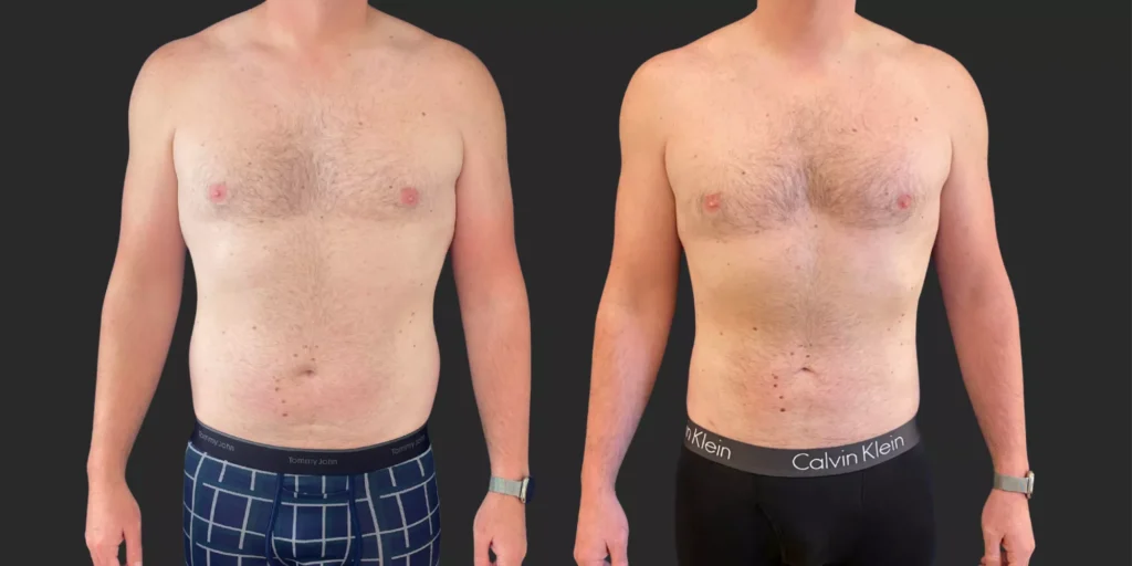 360 Lipo + Lateral Chest #021, before and after photo