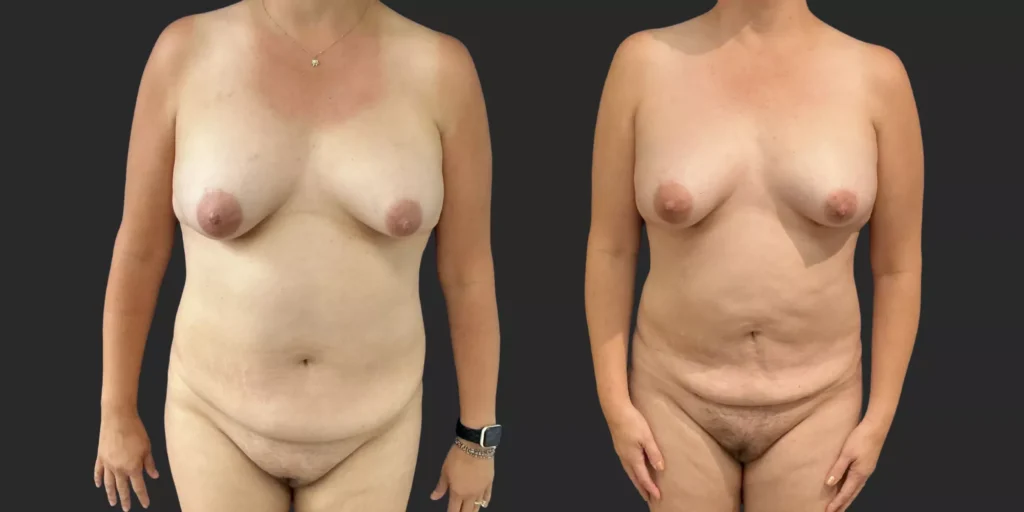 360 Lipo plus pubis #024, before and after photo