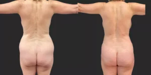 360 lipo plus upper arms #025, before and after photo, view 2