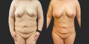 360 Lipo with Fat Transfer to Breasts #026, before and after photo