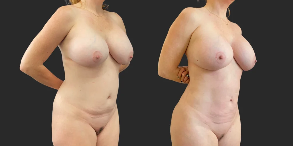 360 Lipo + Outer Thighs #022, before and after photo, view 2
