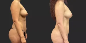 360 LBA plus Liposuction of Arms #008, before and after photo, view 2