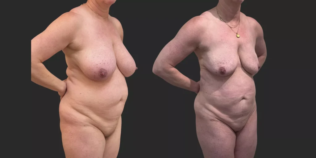 360 Lipo + Lipo of Bilateral Breasts #011, before and after photo, view 2