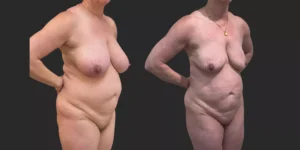 360 Lipo + Lipo of Bilateral Breasts #011, before and after photo, view 2