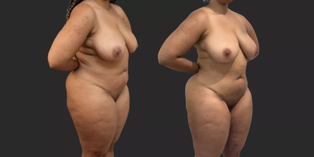 360 Lipo + Outer Thighs #012, before and after photo, view 2