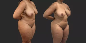 360 Lipo + Outer Thighs #012, before and after photo, view 2