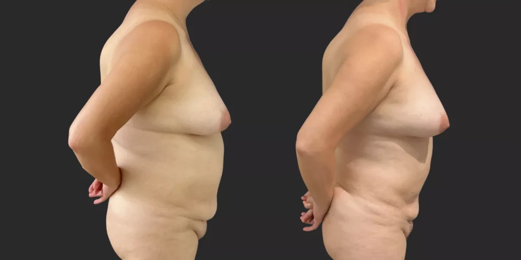 360 Lipo plus pubis #014, before and after photo, view 2