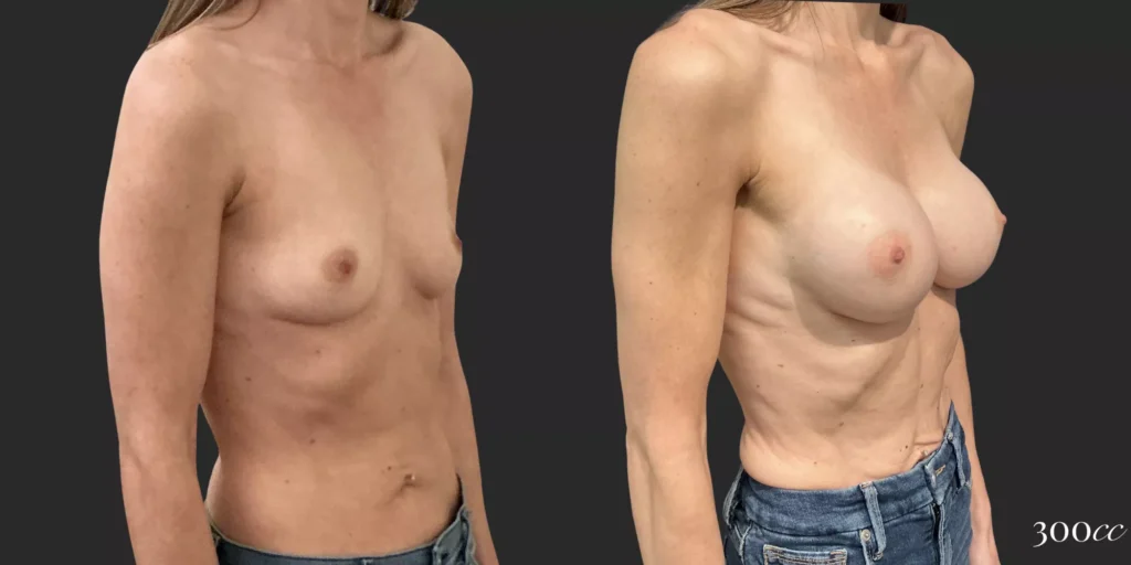 Breast Augmentation #90, before and after photo, view 2