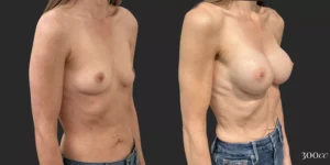 Breast Augmentation #90, before and after photo, view 2
