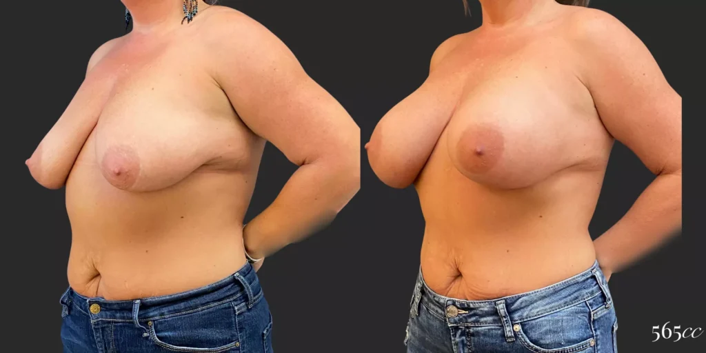 Breast Augmentation #96, before and after photo, view 2