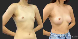 Breast Augmentation #98, before and after photo, view 2