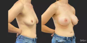 Breast Augmentation #99, before and after photo, view 2