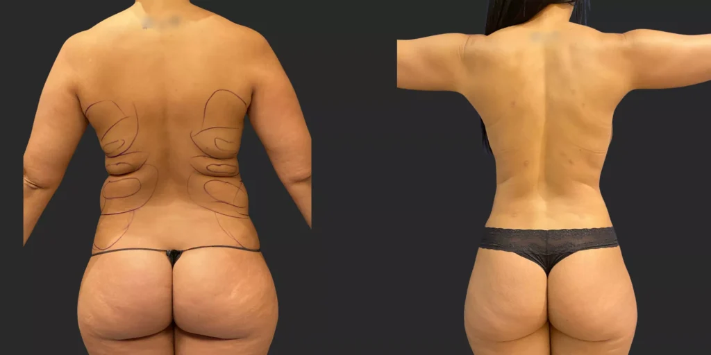 360 Lipo #018, before and after photo, view 2