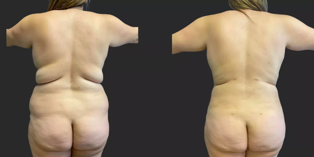 360 Lipo #019, before and after photo, view 2