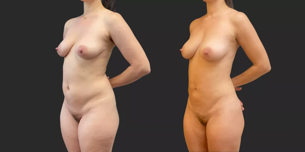 360 Lipo + Inner/Outer Thighs & Knees with Fat Transfer to Breasts #020, before and after photo, view 2