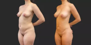 360 Lipo + Inner/Outer Thighs & Knees with Fat Transfer to Breasts #020, before and after photo, view 2