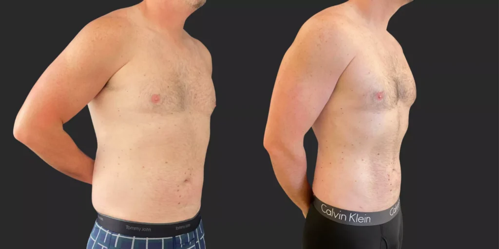 360 Lipo + Lateral Chest #021, before and after photo, view 2