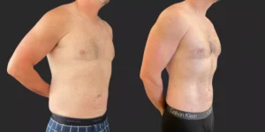 360 Lipo + Lateral Chest #021, before and after photo, view 2