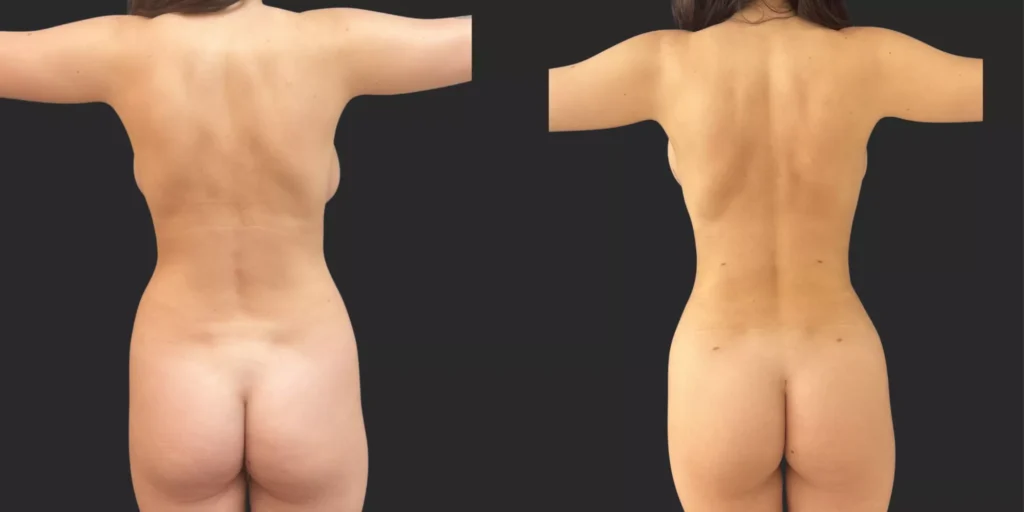 360 Lipo and Breast Reduction Lipo #023, before and after photo, view 2