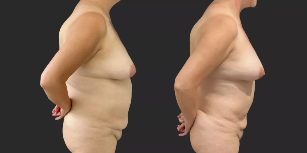 360 Lipo plus pubis #024, before and after photo, view 2