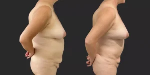 360 Lipo plus pubis #024, before and after photo, view 2