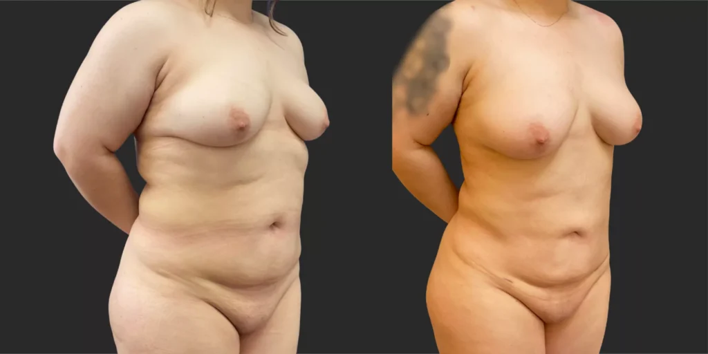 360 Lipo with Fat Transfer to Breasts #026, before and after photo, view 2